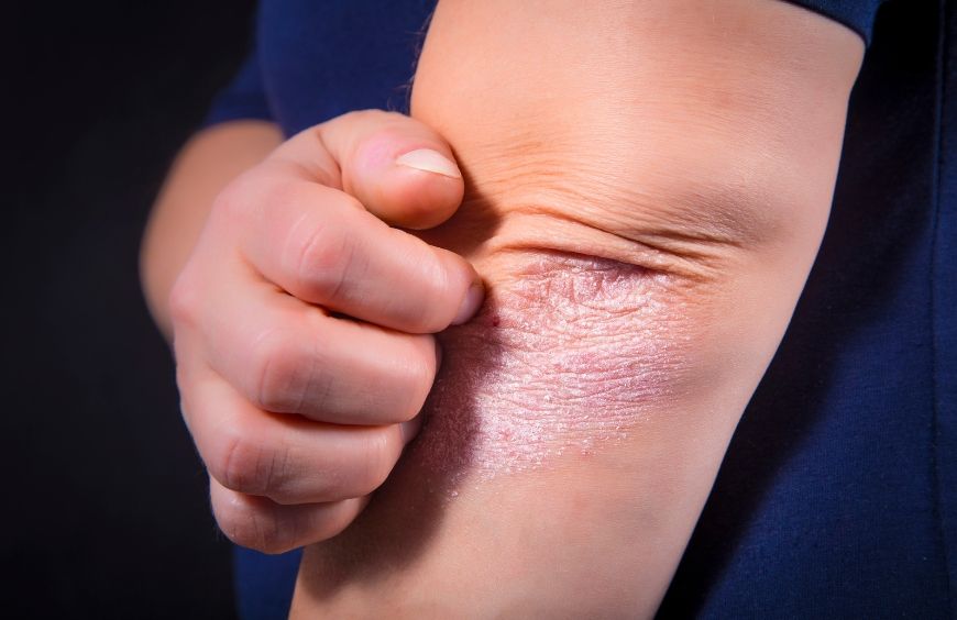Quels sont les bienfaits du cannabidiol contre le psoriasis ?